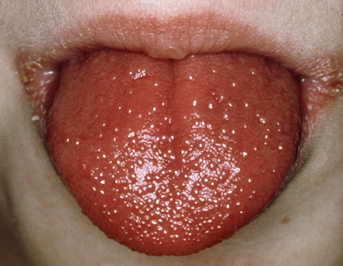 Det farliga epidemisjukhuset i Göteborg